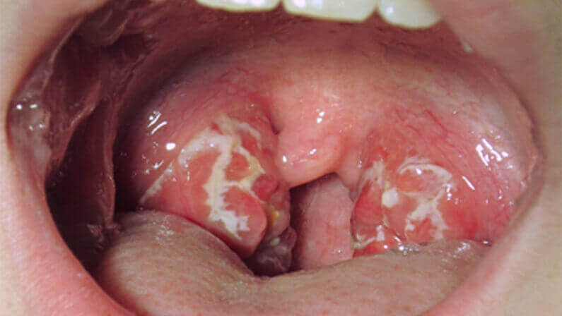 white spot on throat