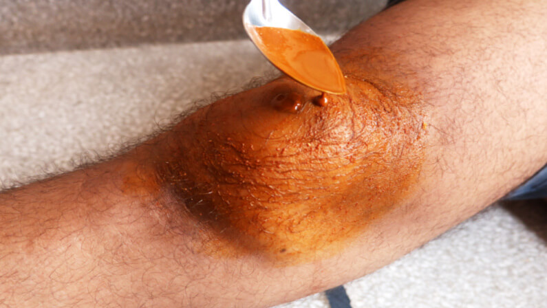 Turmeric Paste for wound