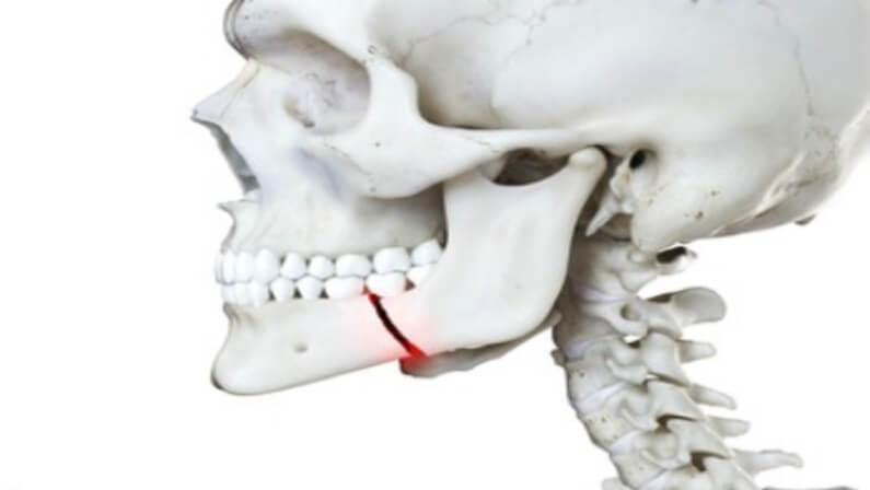 How Long Does A Fractured Jaw Take To Heal?