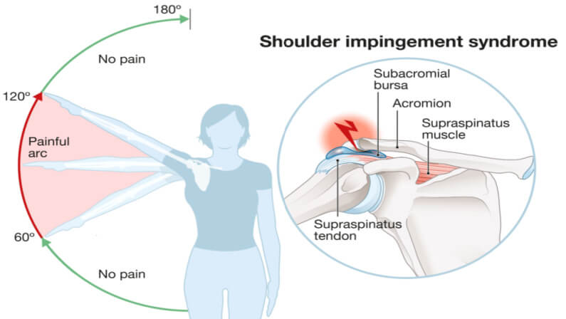 Shoulder Impingement symptoms