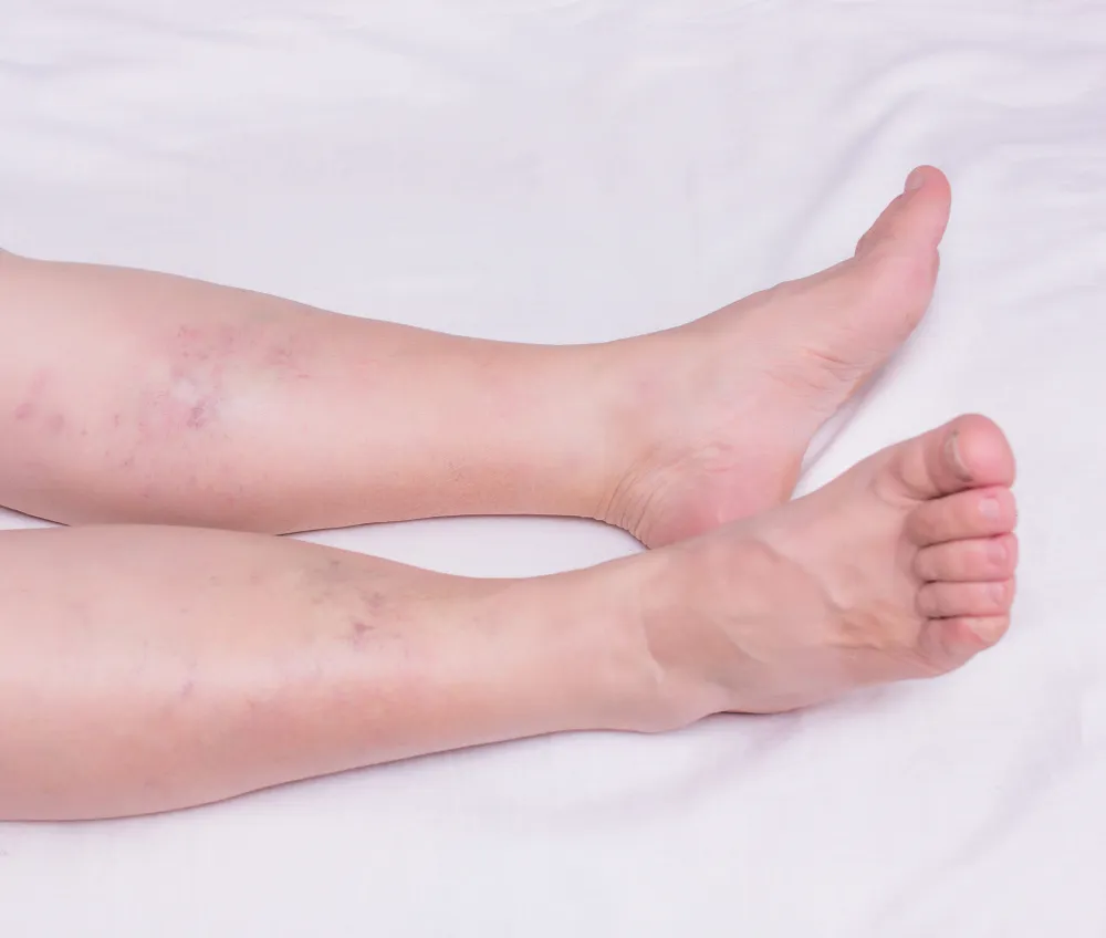 The legs of an elderly woman with varicose veins and thrombosis