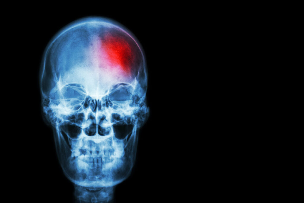 film x-ray skull of human with red area