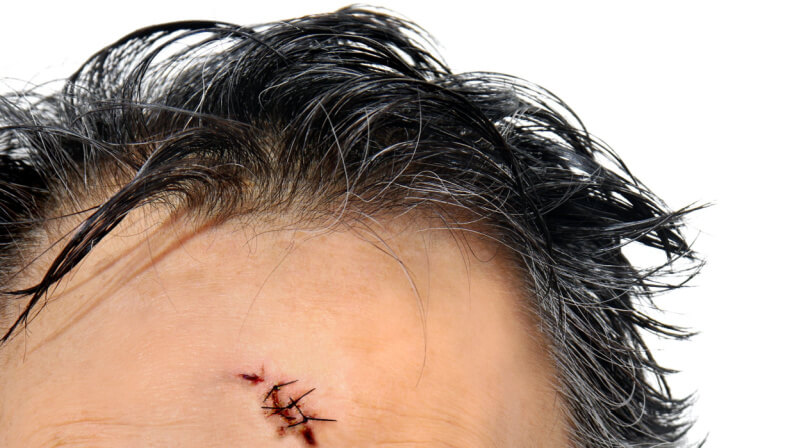 stitches and suture on forehead to assault victim of violence . closeup medical out-patient emergency treatment . 