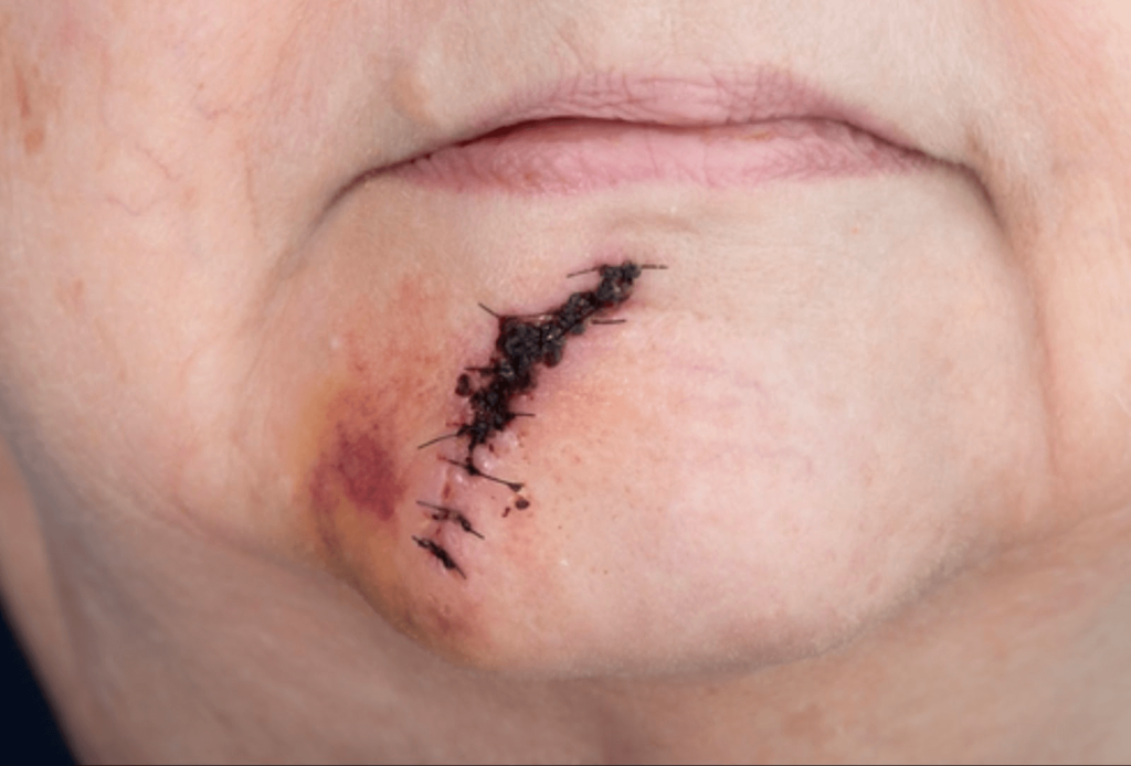 Horizontal shot of a post surgical suture between her lower lip and her chin following skin cancer surgery.