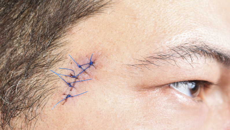 Close-up stitched wounds after skin biopsy on the man's face 