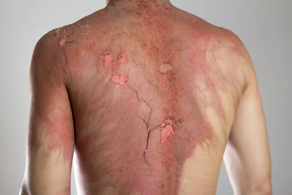 Man with a severe burn all over his body.