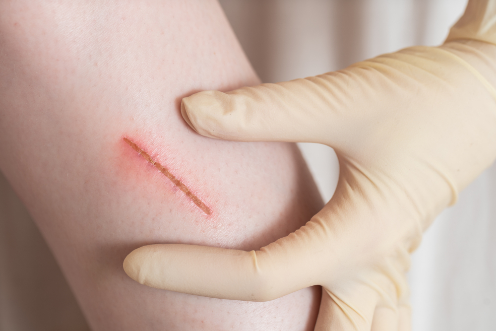 Cleaning of the wound form nurse. Close up