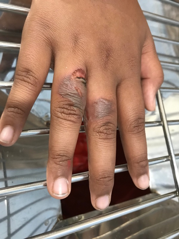 Child's Hand Was Burned