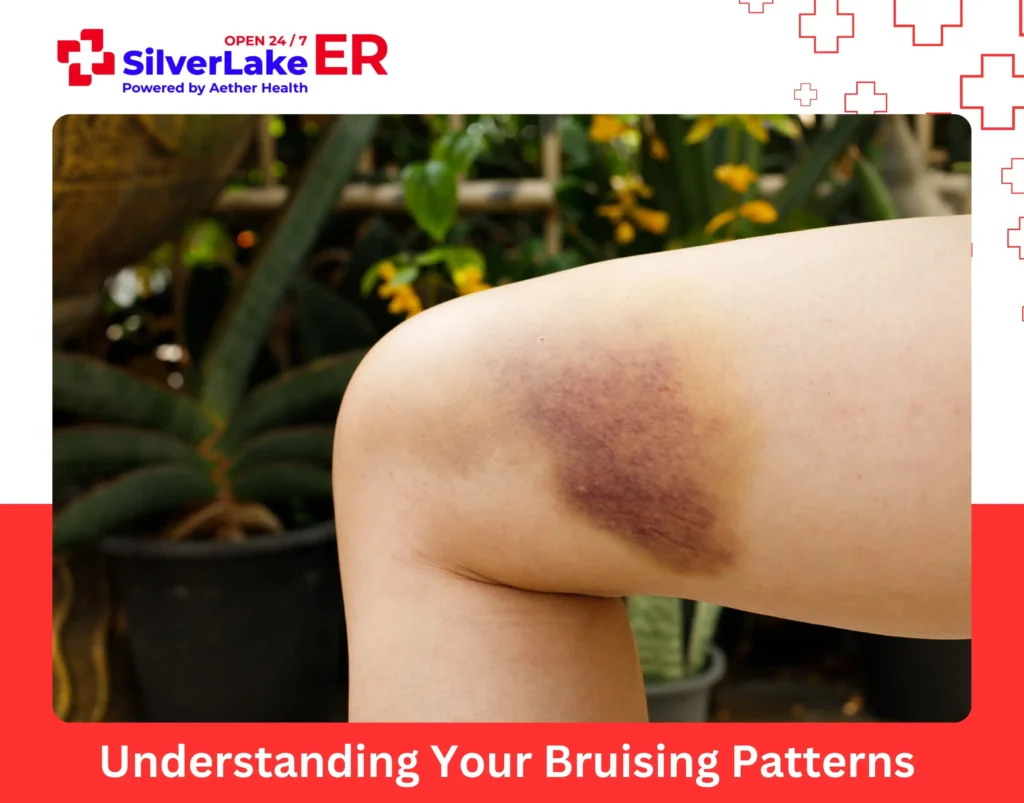 Understanding Your Bruising Patterns