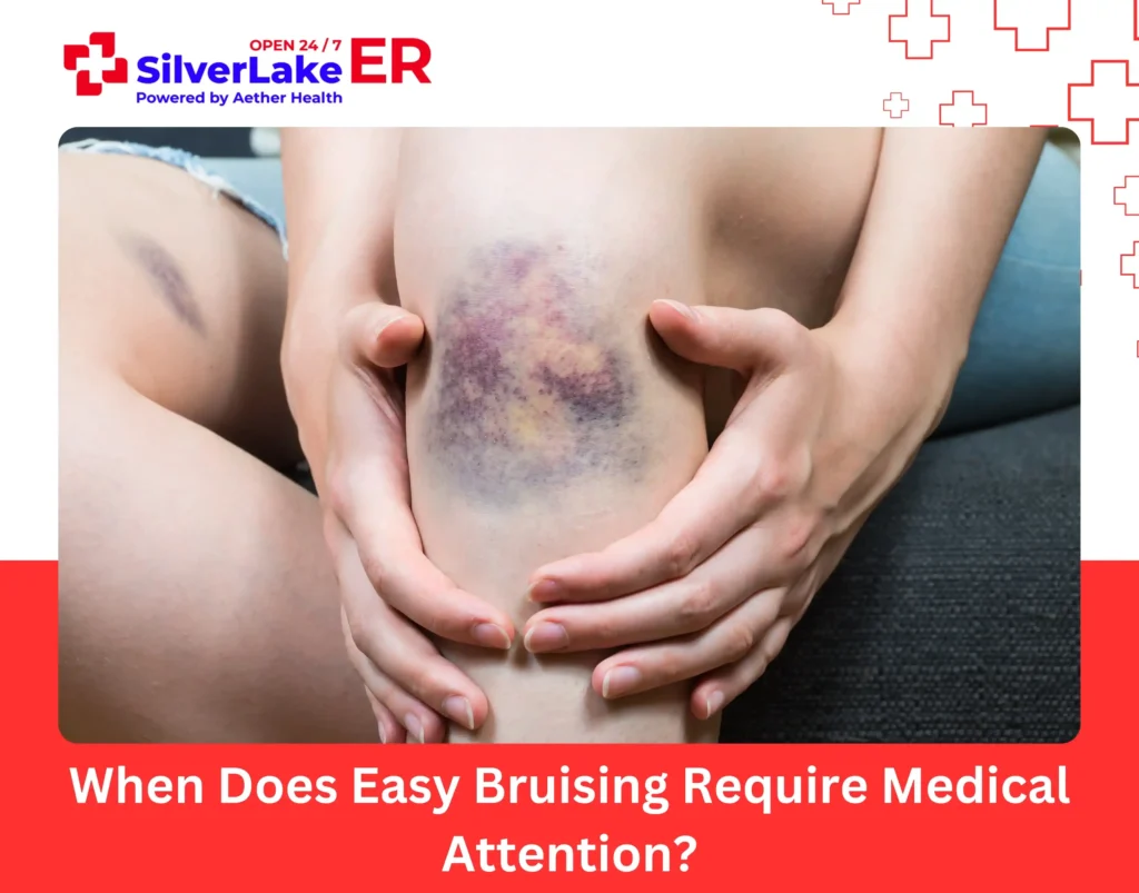 When Does Easy Bruising Require Medical Attention