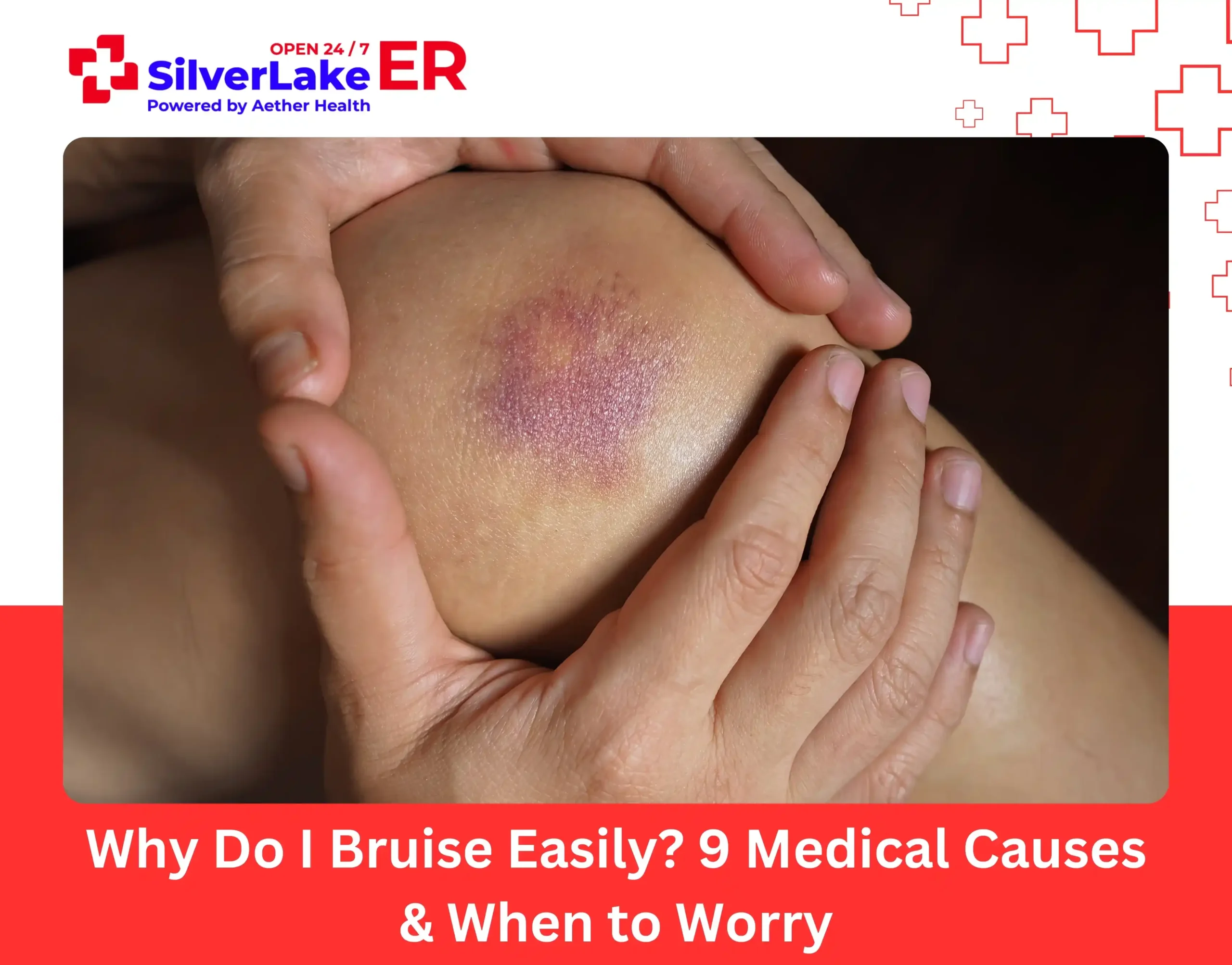 Why Do I Bruise Easily 9 Medical Causes & When to Worry