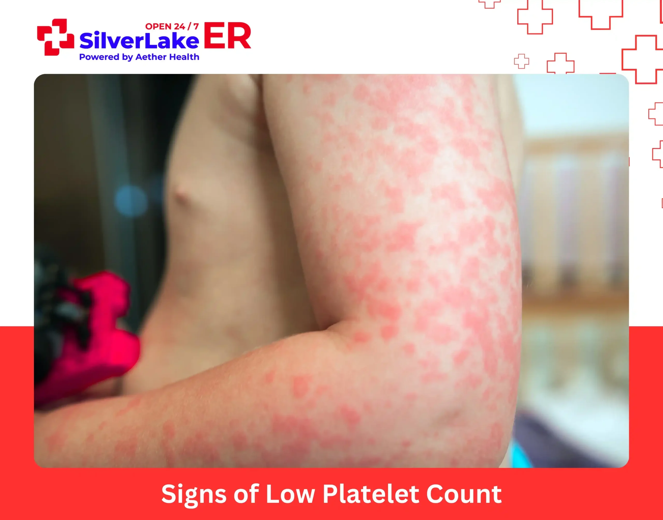 Signs of Low Platelet Count What to Watch For and When to See a Doctor