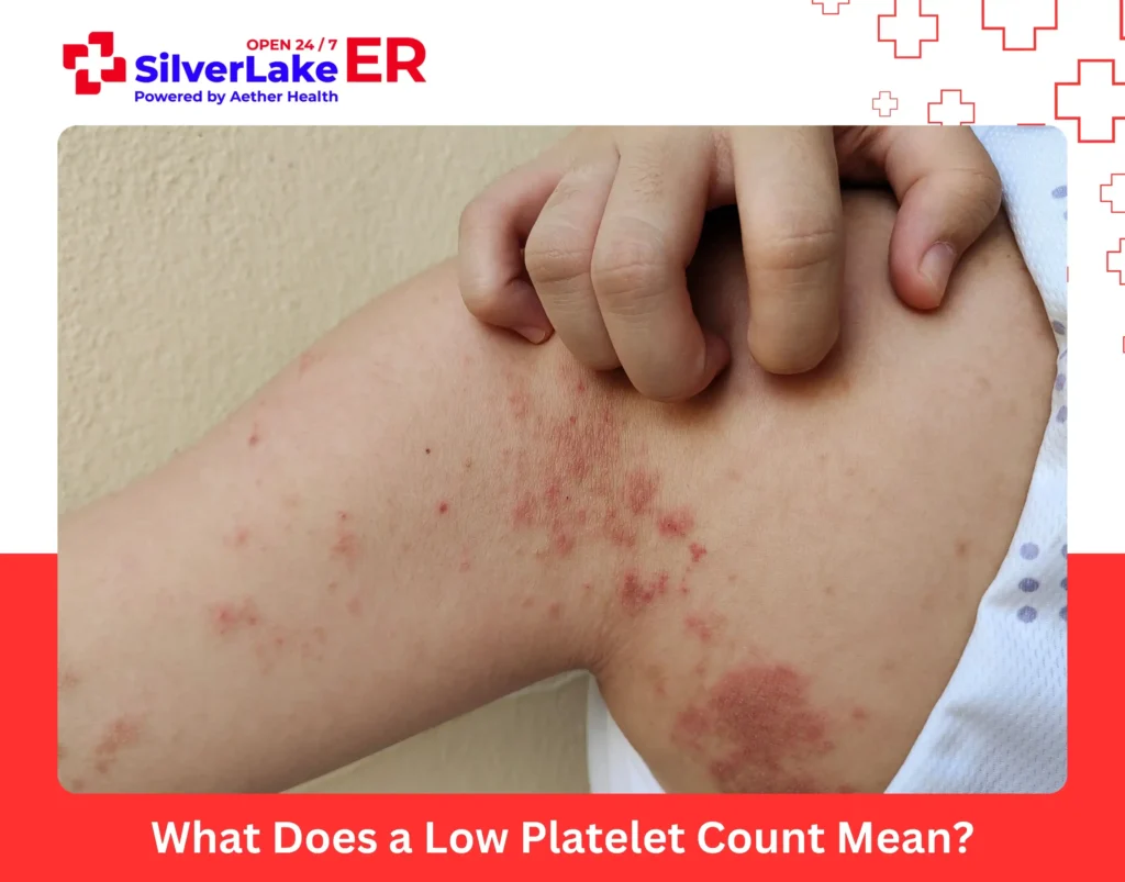 What Does a Low Platelet Count Mean