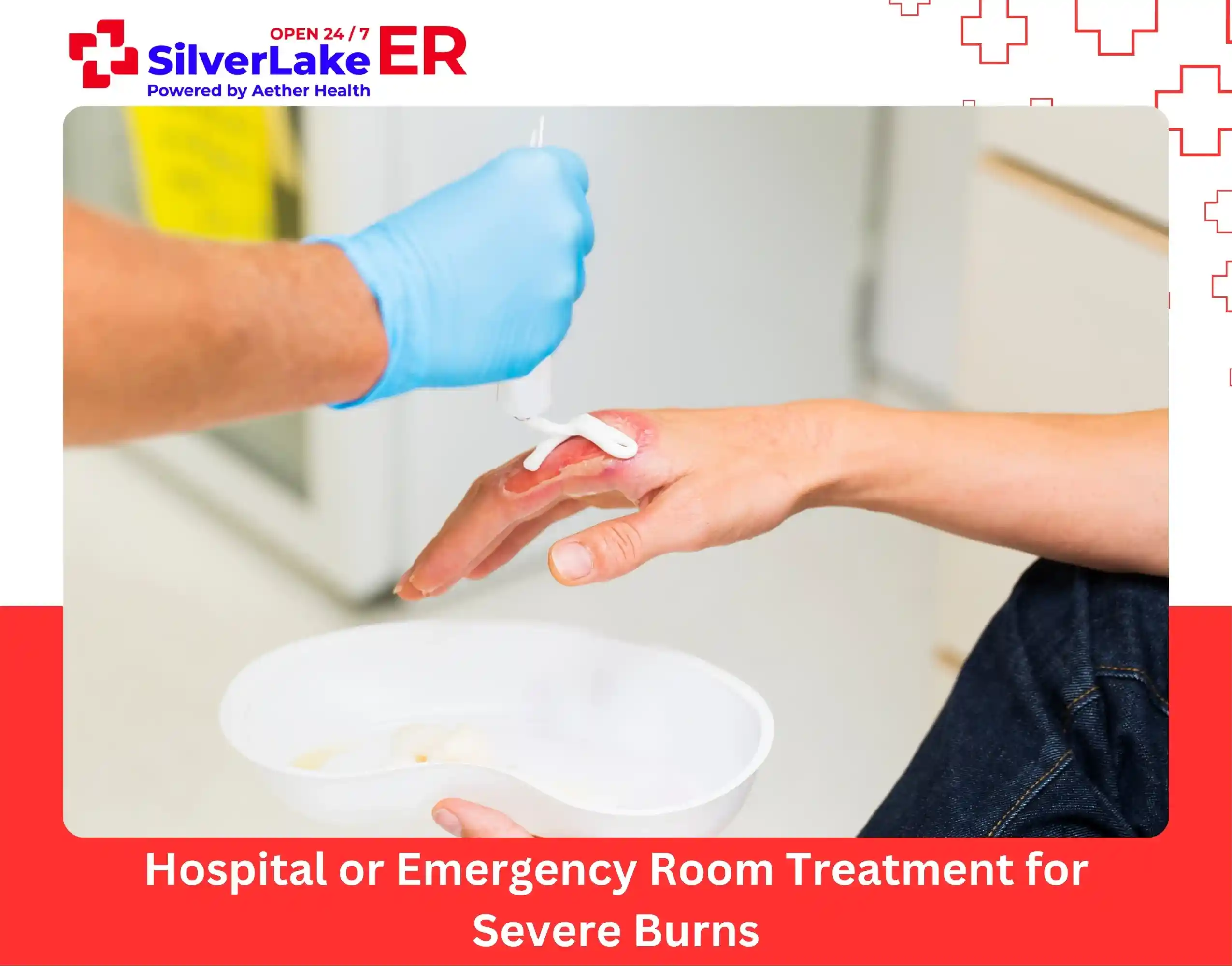 Hospital or Emergency Room Treatment for Severe Burns