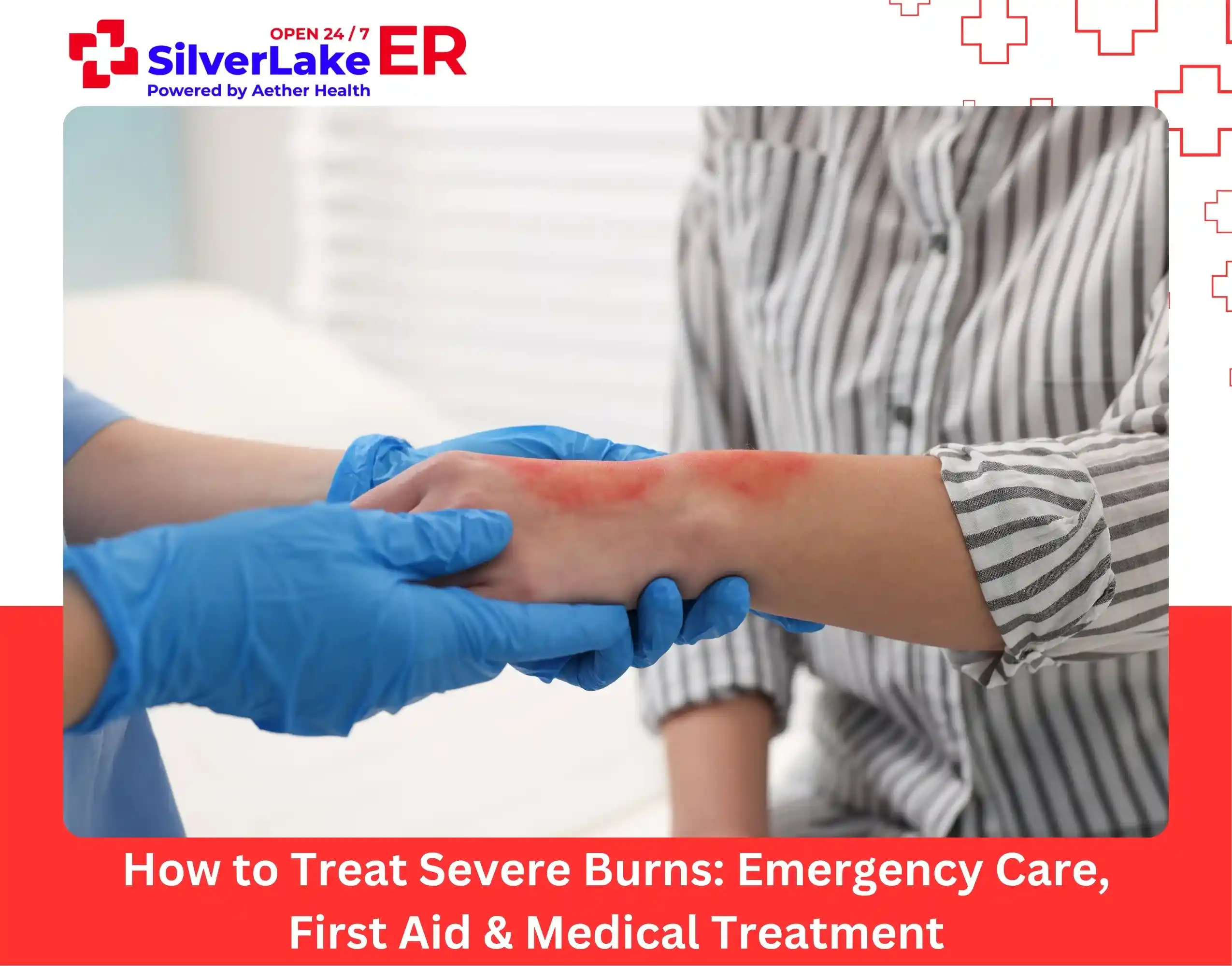 How to Treat Severe Burns Emergency Care, First Aid & Medical Treatment