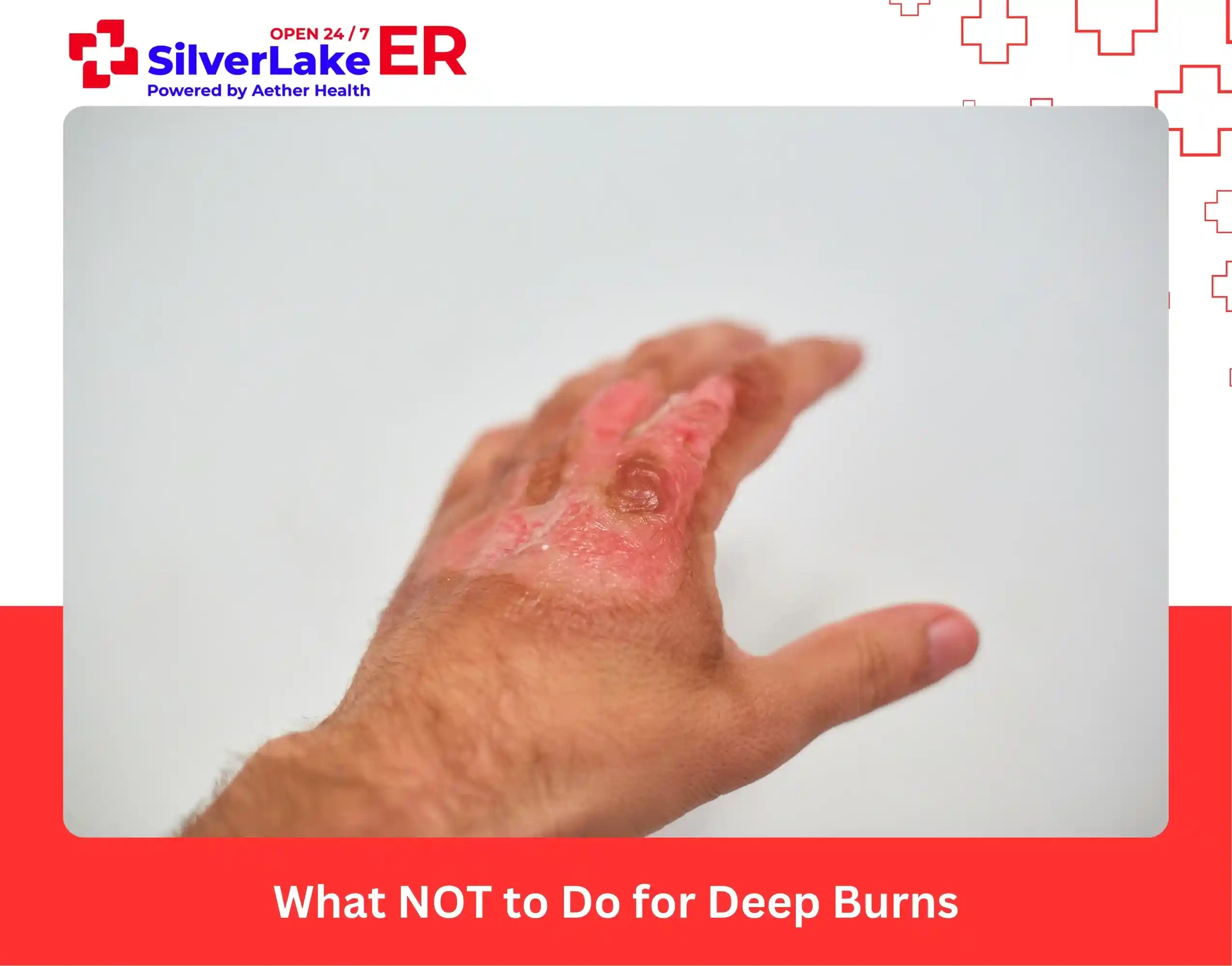 What NOT to Do for Deep Burns