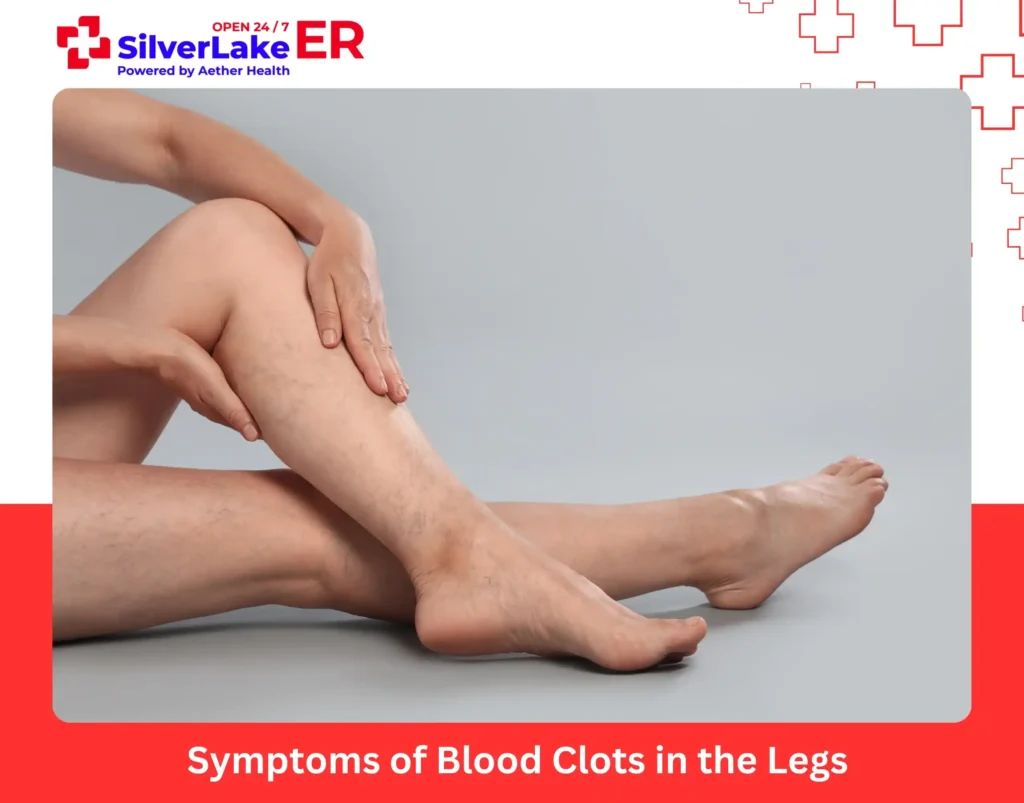 Symptoms of Blood Clots in the Legs