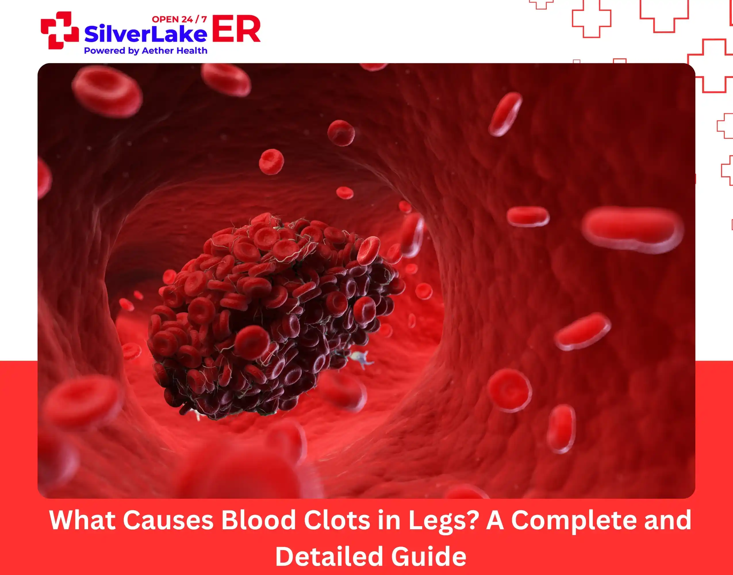 What Causes Blood Clots in Legs
