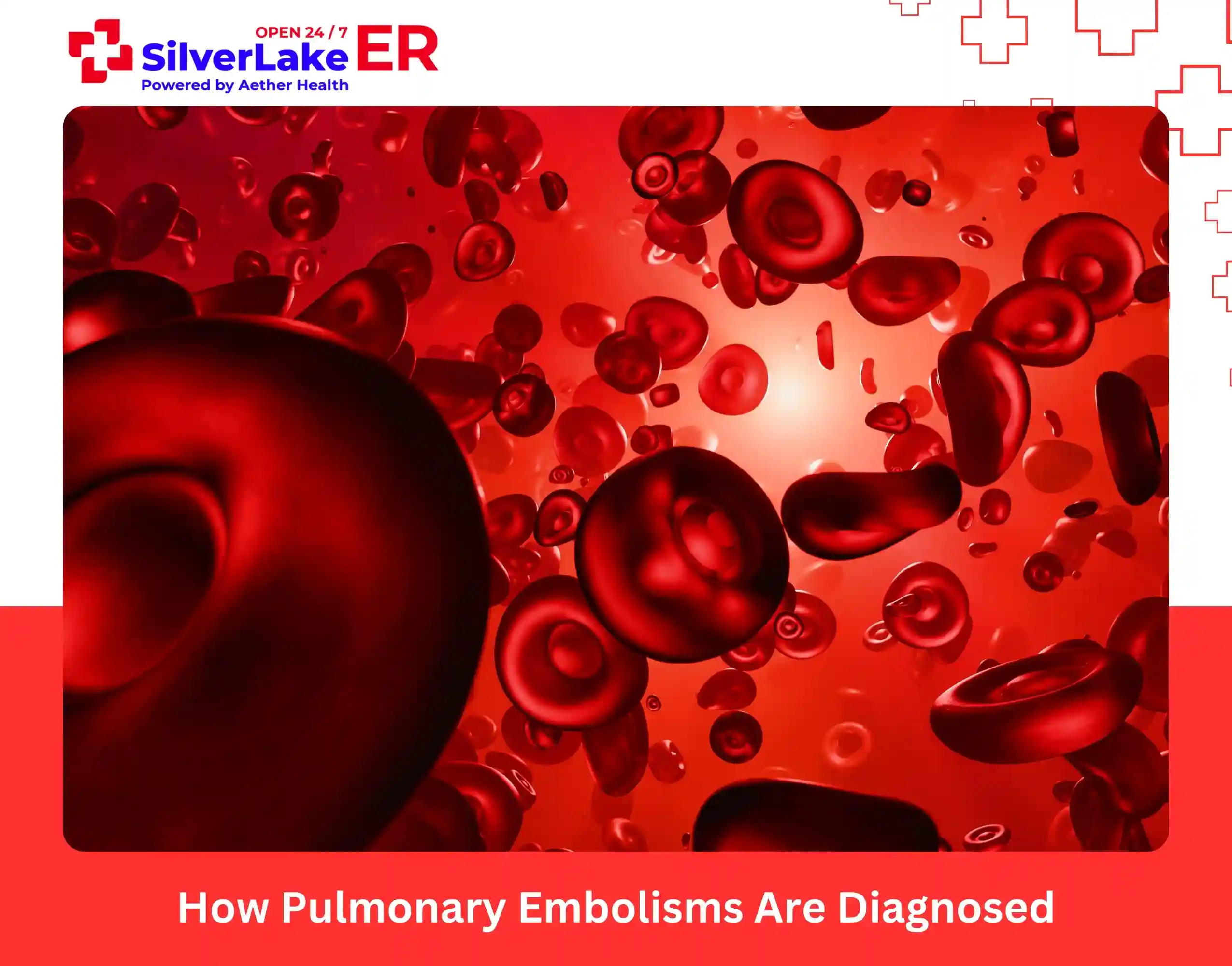 How Pulmonary Embolisms Are Diagnosed