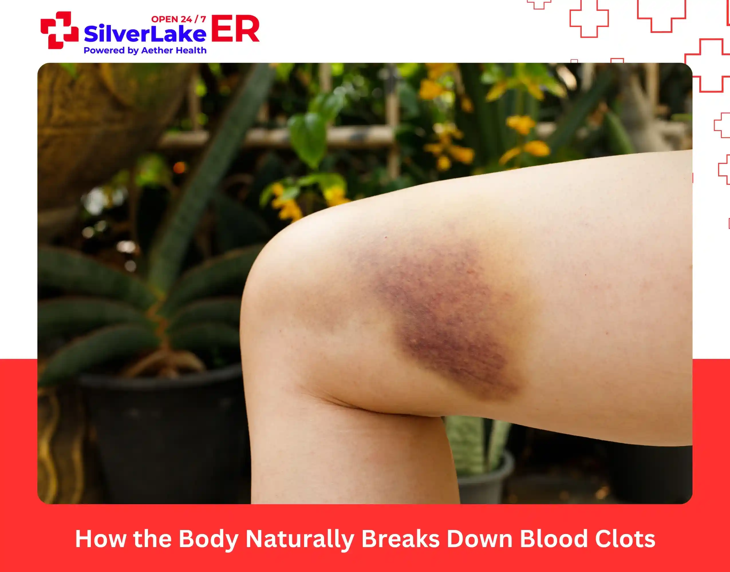 How the Body Naturally Breaks Down Blood Clots