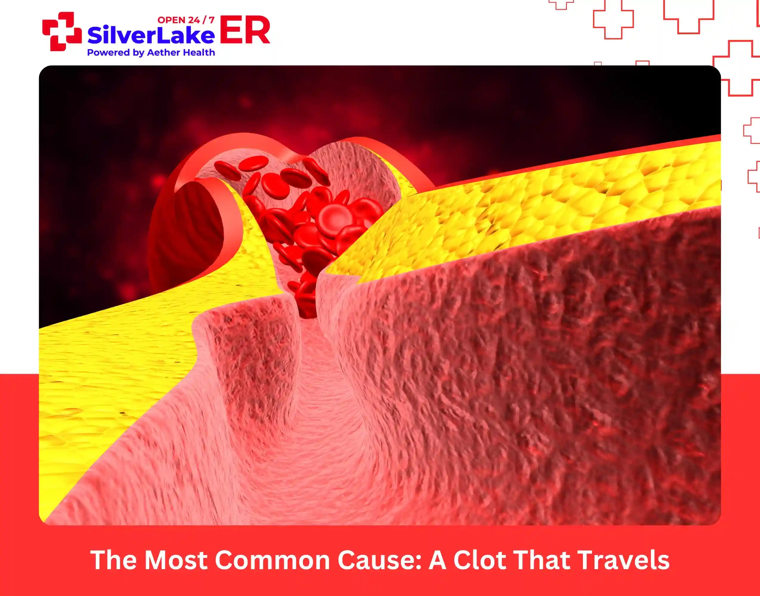 The Most Common Cause A Clot That Travels
