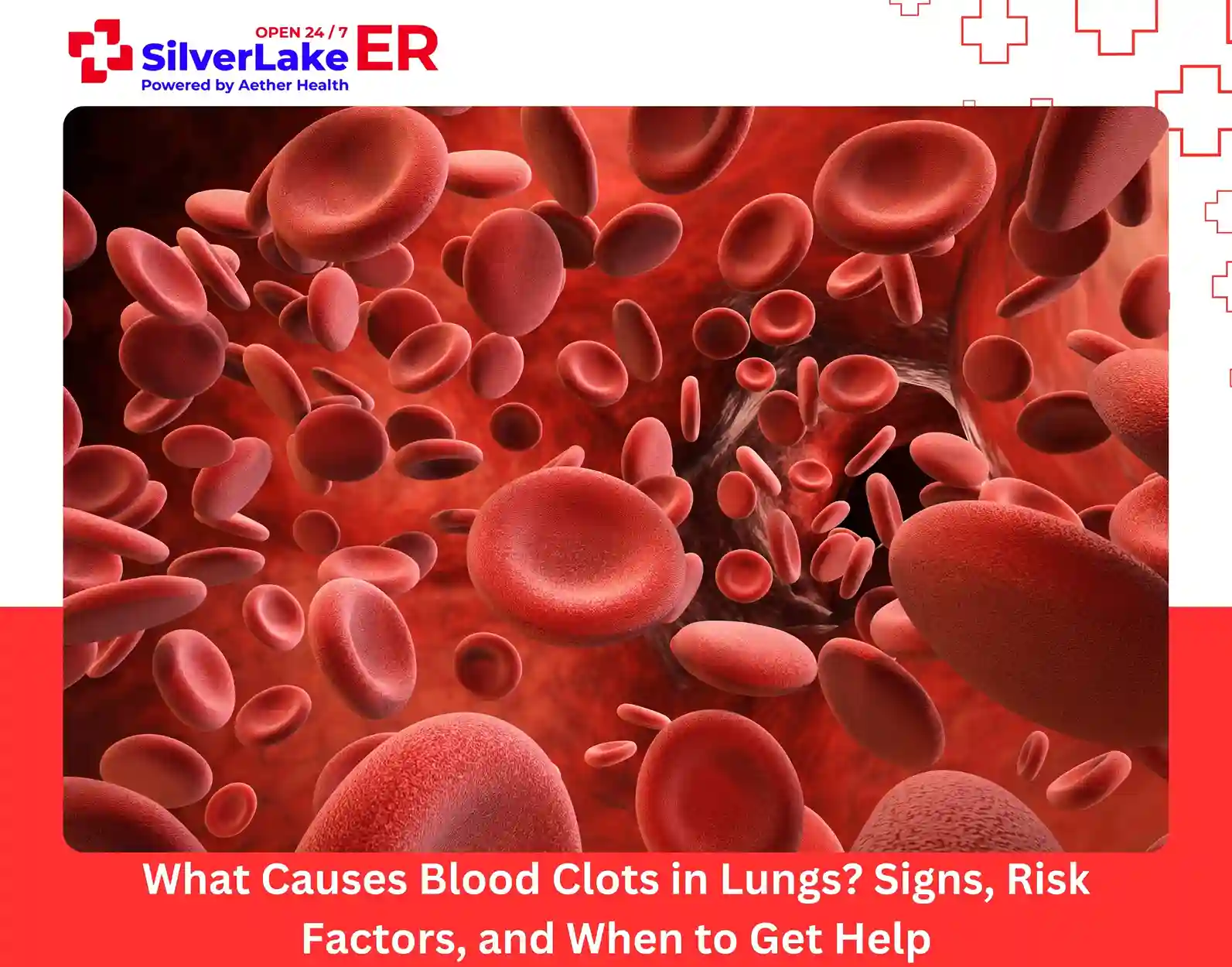 What Causes Blood Clots in Lungs Signs, Risk Factors, and When to Get Help