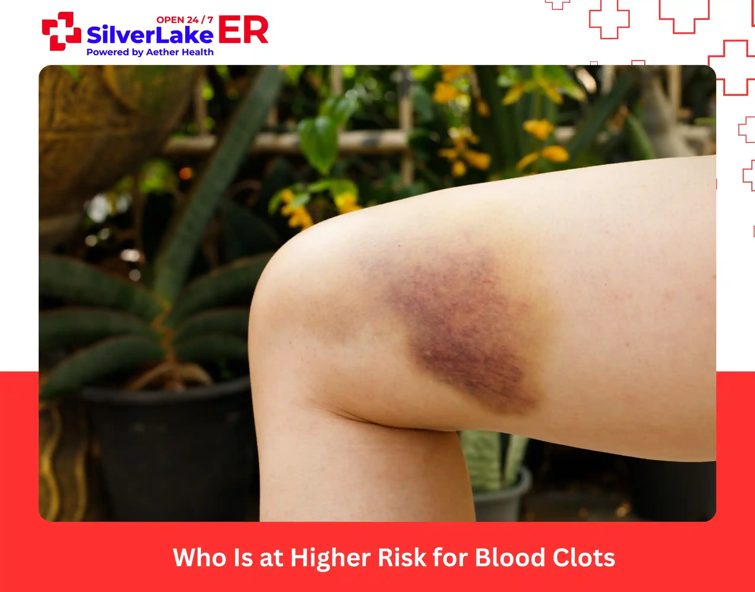 Who Is at Higher Risk for Blood Clots