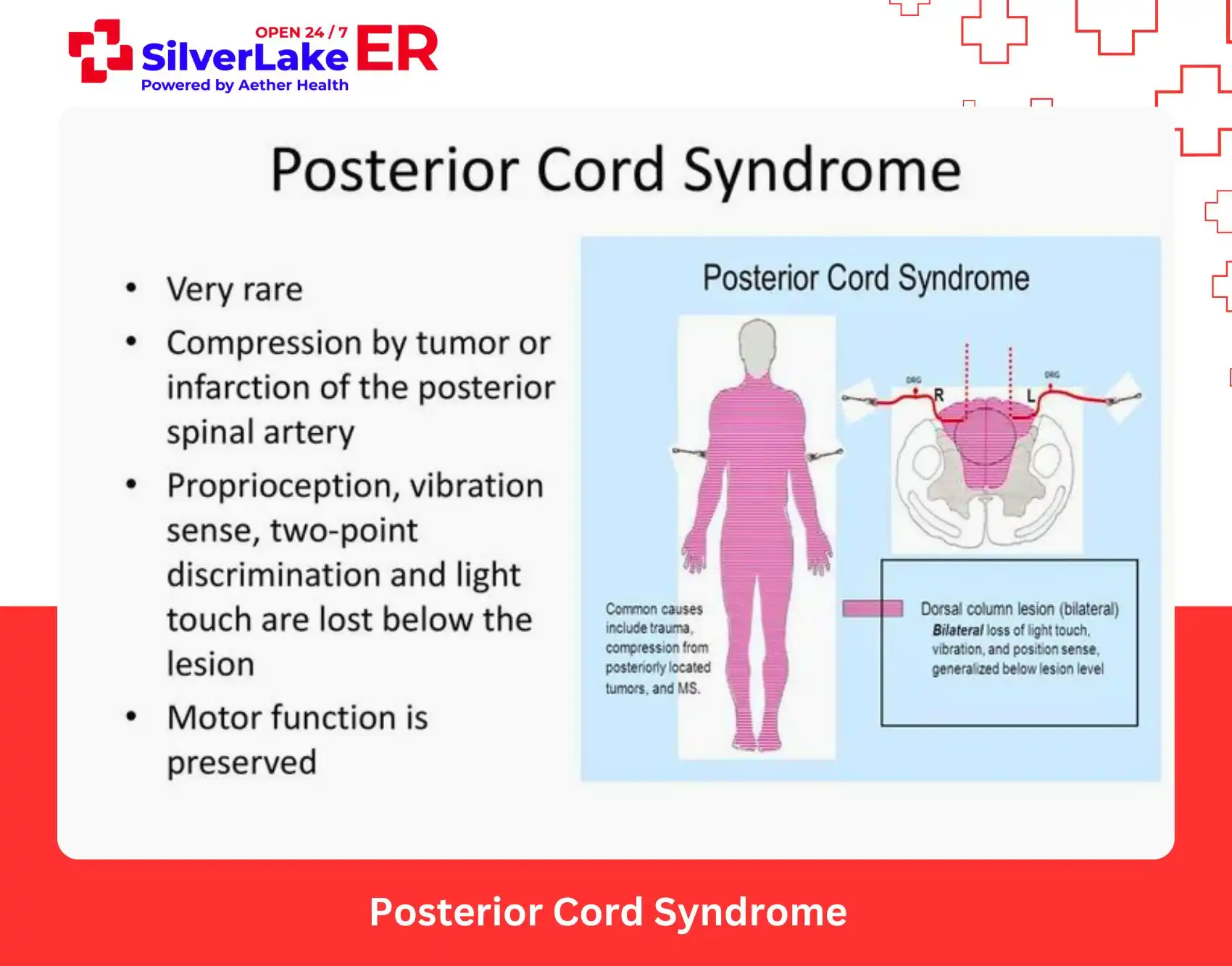 cauda equina syndrome warning signs chart