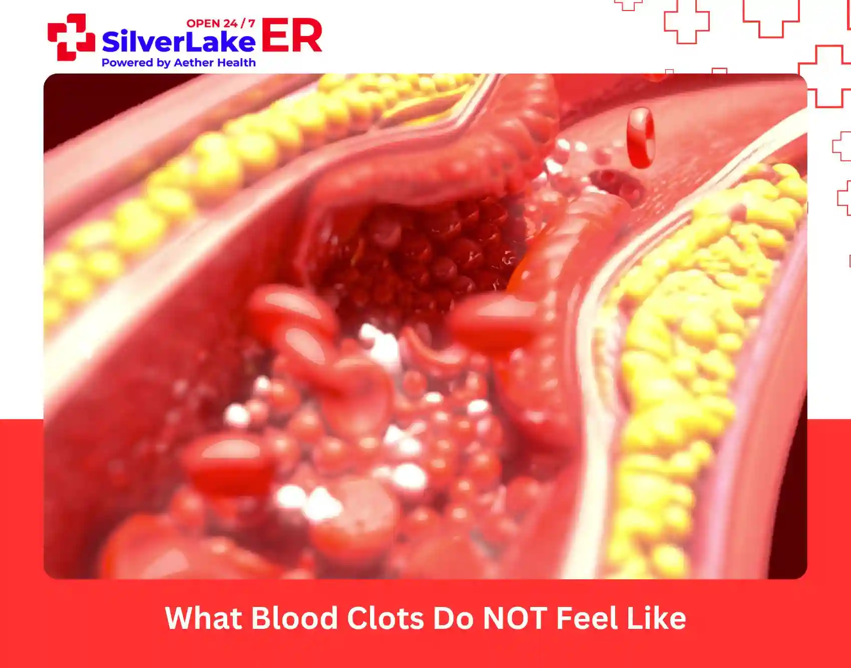 What Blood Clots Do NOT Feel Like