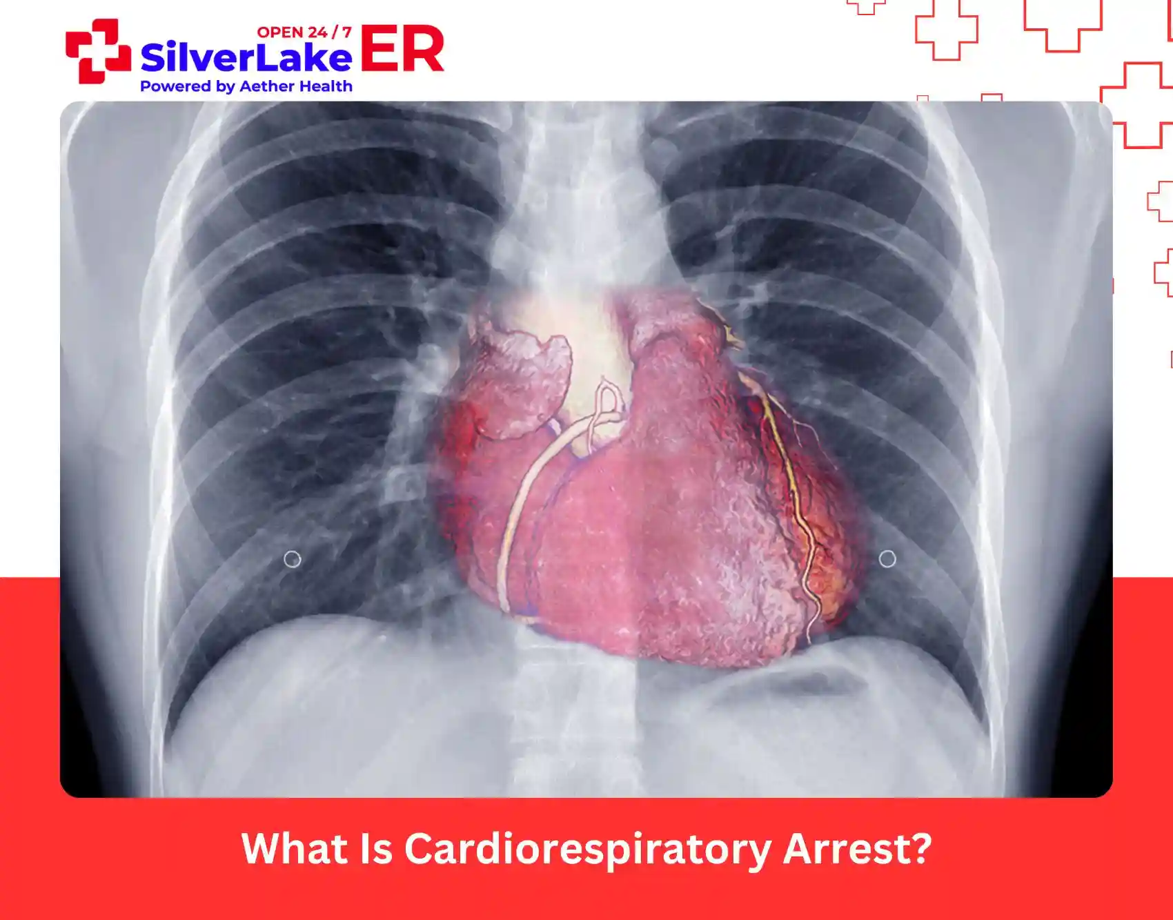 What Is Cardiorespiratory Arrest
